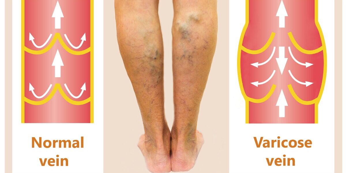 Varicose Vein Treatment