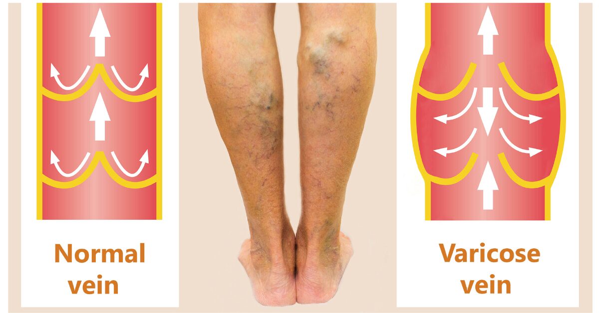 Varicose Vein Treatment