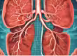 Acute Bronchitis ICD-10 Code J20.9