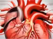 Myocardial Infarction ICD-10-CM Codes